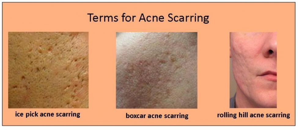 The Do’s and Don’ts of Skin Scar Removal - Biotyful.net