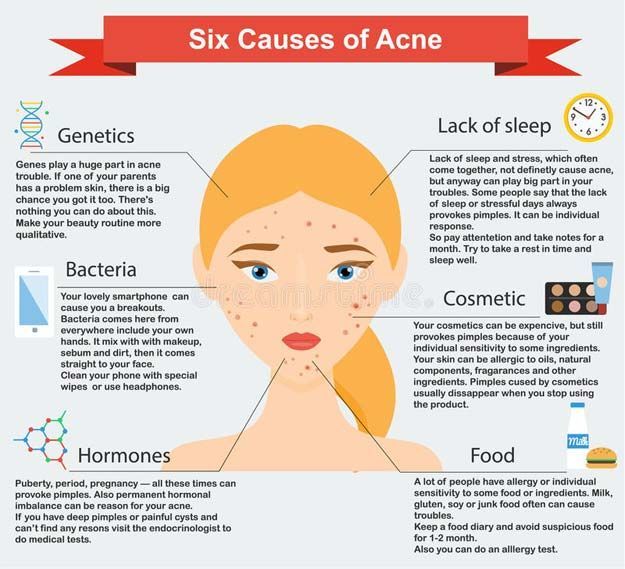 causes of acne