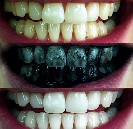 7 Secrets to Whiten your teeth with charcoal Fast - Biotyful.net