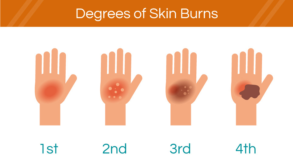 degrees of skin burnt