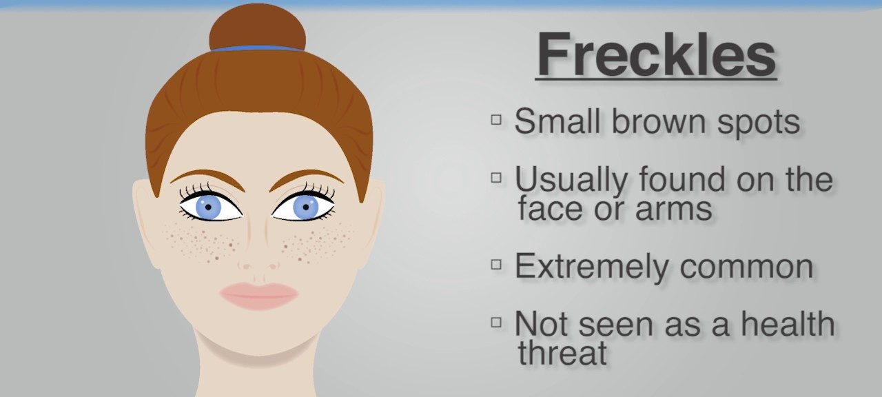 Remove moles and to freckles naturally how 