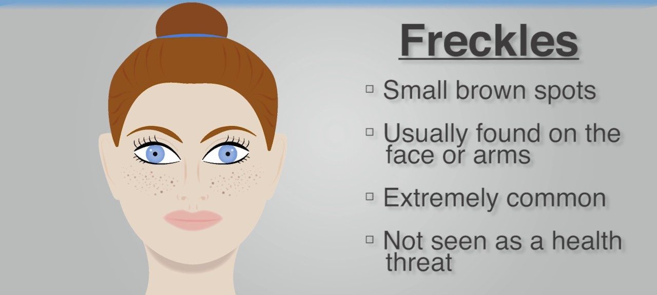 get rid of freckles