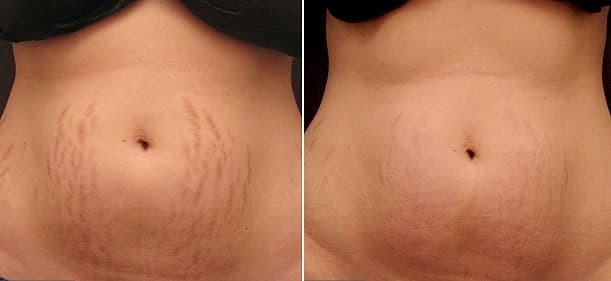 surgery for stretch mark