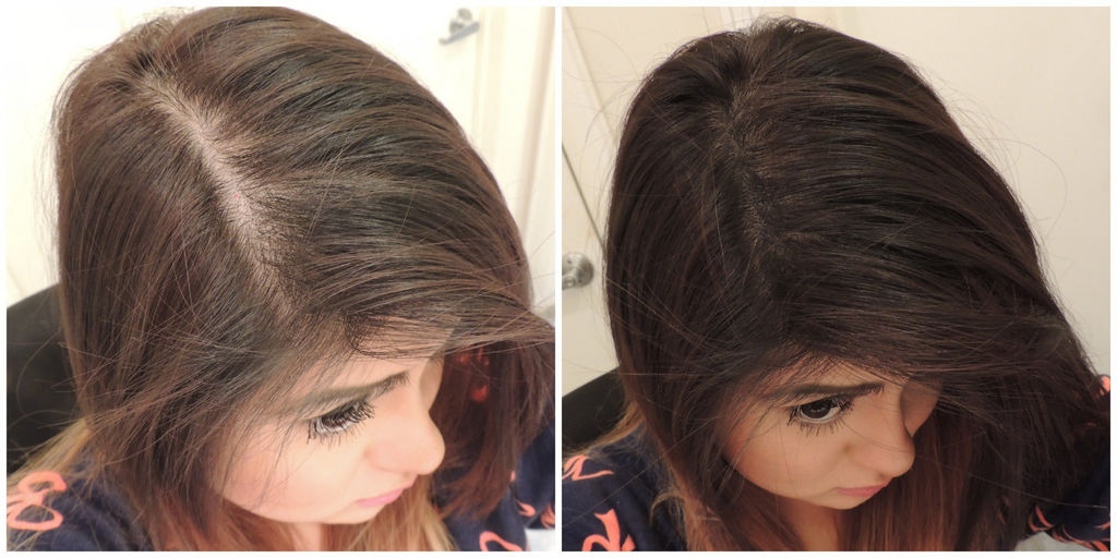 Top 5 Best Hair Regrowth Treatment For Women