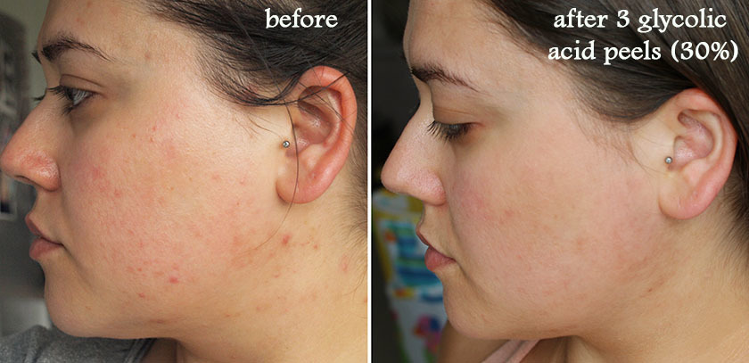 before and after glycolic acid peel